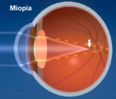 Miopia