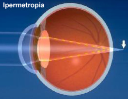 Ipermetropia
